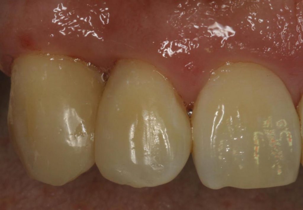 Aesthetische Behandlung Zahnarzt Nachher Frankfurt -