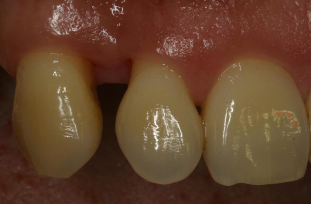 Aesthetische Behandlung Zahnarzt Vorher Frankfurt -